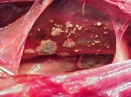 Аспергиллез 