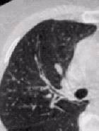 Бронхиолит 