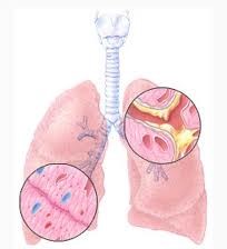Бронхит токсический 