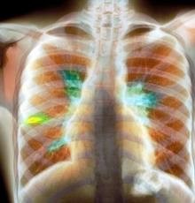 Бронхоаденит туберкулезный 