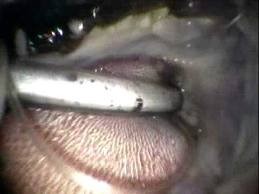 Инородное тело глотки 