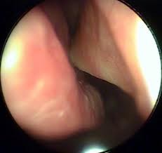 Инородное тело трахеи и бронхов 