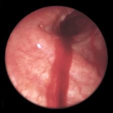 Кровотечение легочное 