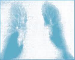 Легочное сердце 