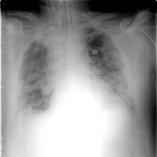 Отек легких 