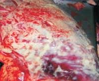 Плеврит гнойный 