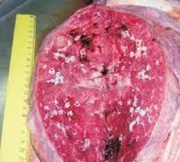 Пневмосклероз 