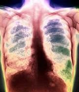 Профессиональные заболевания легких 