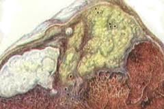 Туберкулема легких 