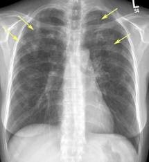 Эозинофильные инфильтраты 