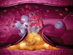 Тромбоэмболия, инфаркты легкого 