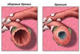Бронхит 