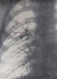 Бронхоэктазы 