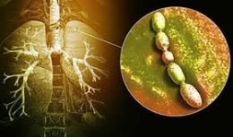 Пневмония (воспаление легких) 