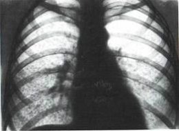 Саркоидоз (болезнь Бенье-Бёка-Шаумана)