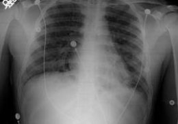 Синдром Гудпасчера 