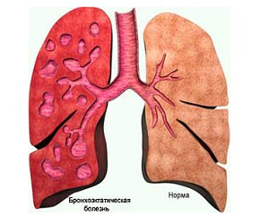 Диагностика бронхоэктатической болезни