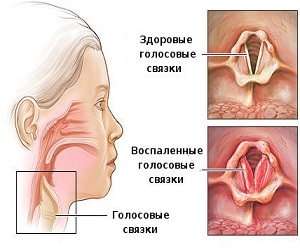 Признаки ларингита у взрослых