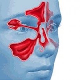 МРТ пазух носа: показания 